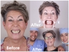 Full Mouth Rehabilitation Top Dentist in Los Algodones