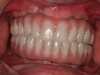 Full mouth dental implants in Los Algodones, Mexico dentist