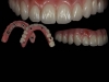 Algodones dentist overdentures secured with full mouth implants