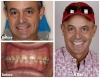Veneers Los Algodones dentist