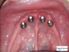 Dental Implant expert in Tijuana Dr. Tulio