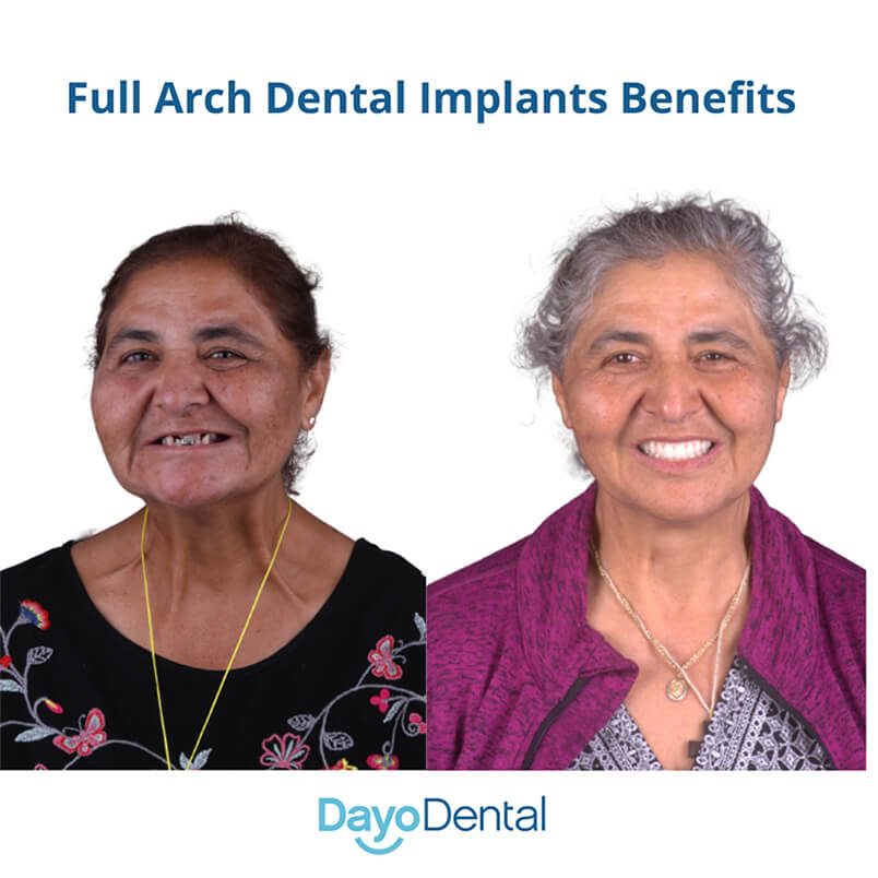 Full Arch Dental Implants Benefits