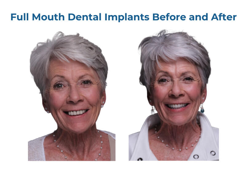 Full Mouth Dental Implants Mexico