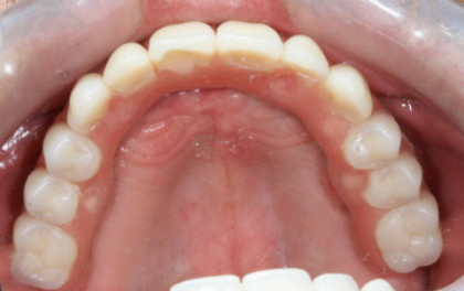 Implant supported dentures make a big difference.