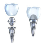 Why understanding dental implant abutments can save you an extra trip (and money) to Mexico?