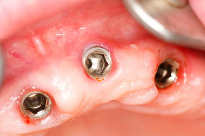 A macro shot of dental implants in the oral cavity (human mouth).