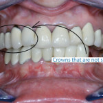 Dental Crown Problem: Learn how to avoid getting bad teeth crowns