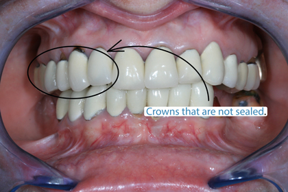 Old crowns that show gaps need to be replaced.  However, dental crown problems can also occur with newly installed crowns.
