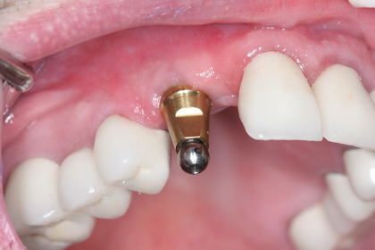 Lost a tooth?  Consider a dental implant as replacement.
