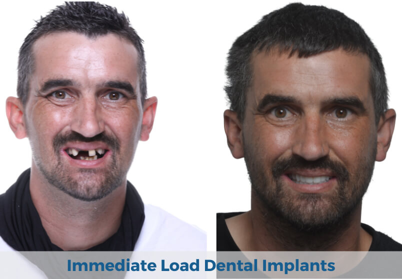 Immediate Load All on 4 Dental Implants