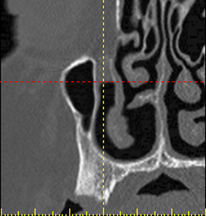Implant surgery in Algodones using 2D Cross sectional view of the jaw from CT Scan