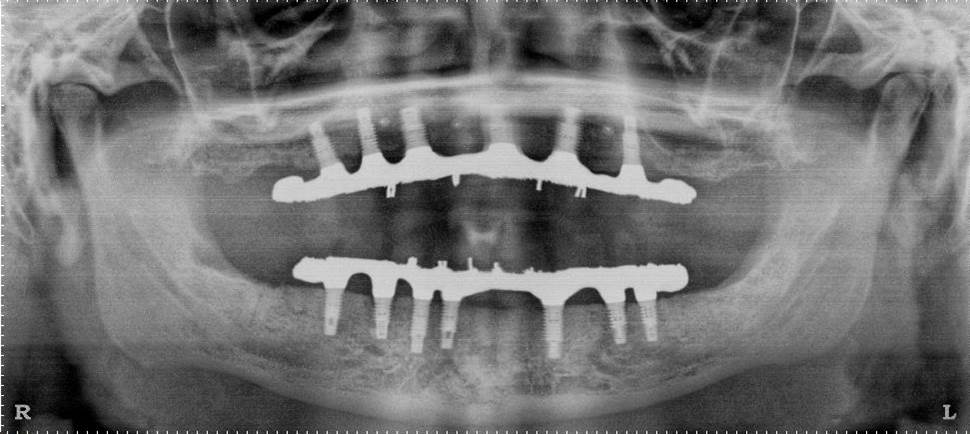 of full mouth dental implants