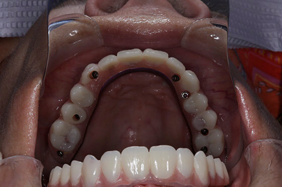 Full Mouth Restoration using Dental Implants