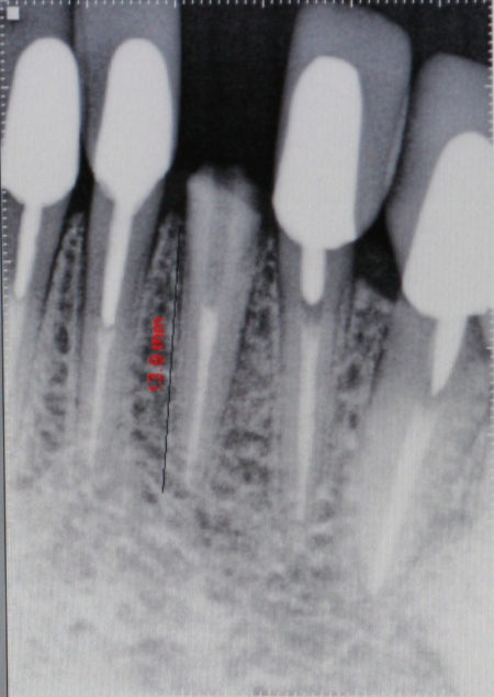 Root Canal in Mexico that needs a post and crown