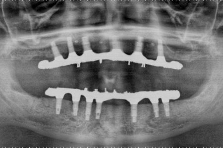 All on 4 dental implants in Mexico vs standard dental implants