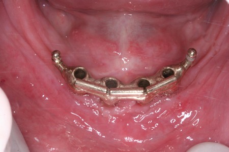 Full mouth implants in Mexico