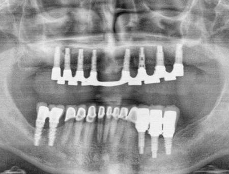 Dental Implant surgery in Mexico