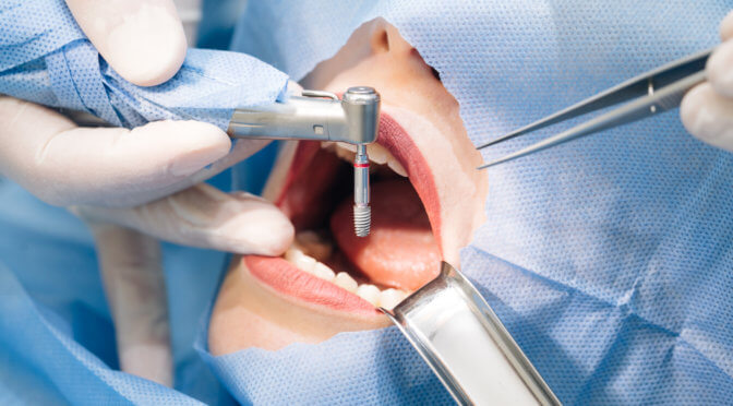 installation of dental implant
