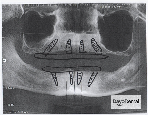 All on 4 Dental Implants in Mexico Picture of Implant Angle Position