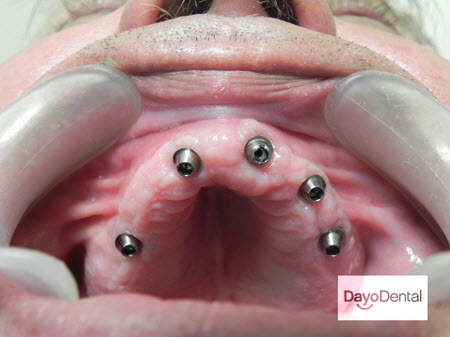 Fully healed full upper dental implants in Mexico for dental tourism patient