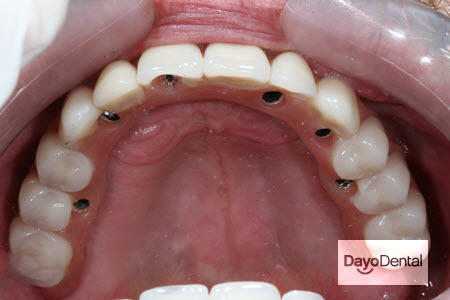 Full Fixed Bridge Dental Implants Picture in Mexico | Cancun, Yuma, Los Algodones, Tijuana