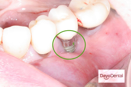 Not enough gum tissue on Dental Implant in Mexico | Tooth Implant complication picture
