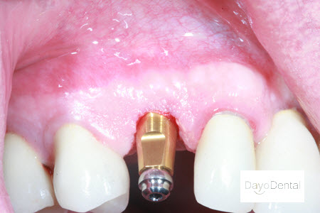 Single Tooth Dental Implant Picture | Dental Implant in Tijuana, Los Algodones, Cancun Mexico