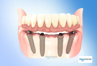 All on 4 dental implants in mexico cost