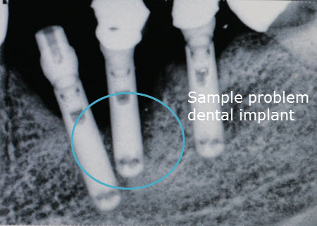 Mexico dentist problem with dental implant work