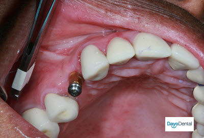 Price of Dental implants in mexico for teeth replacement