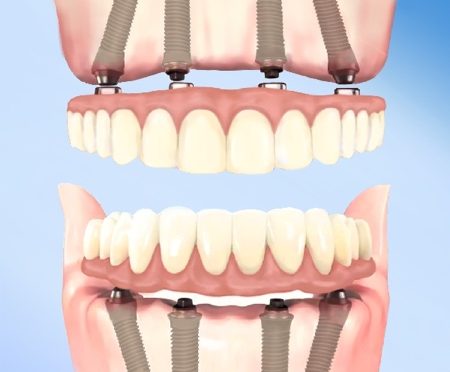 All on 4 dental implants illustration, picture image angled implant post