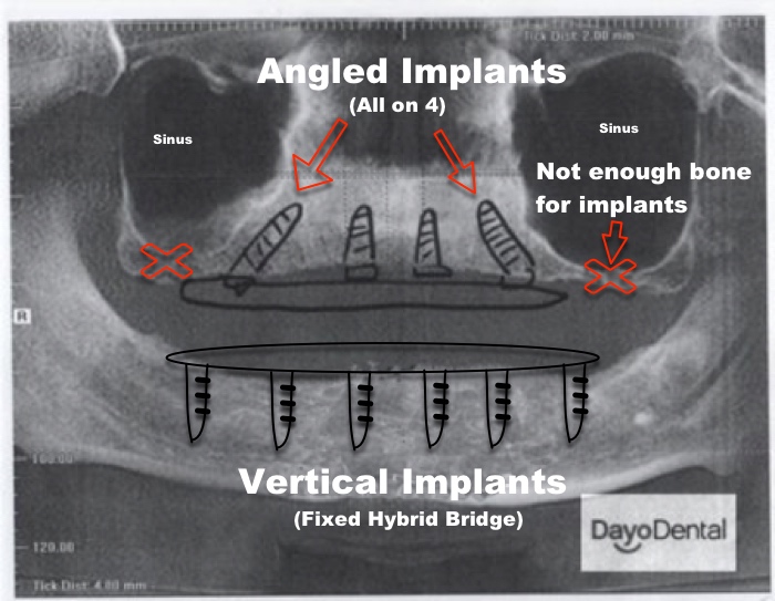 All on 4 Dental Implants vs Fixed Bridge Zirconia or Hybrid. Angled implant vs standard vertical implants.