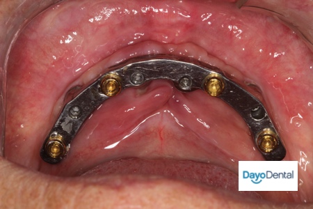 Implant Dentures with Bar with no palate by Mexico dentist
