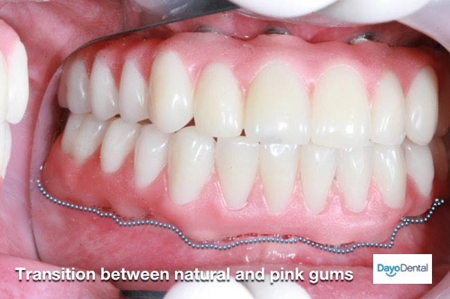 Gum line denture implants vs zirconia fixed bridge - how think are the gum line on the false teeth