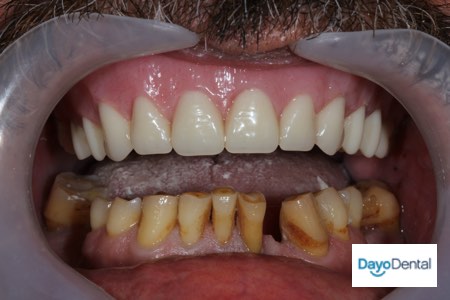 Affordable Denture Implants in Mexico to full smile makeover