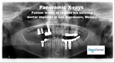 Get estimate cost by submitting your Panoramic Xrays to your Los Algodones Dentist in Molar City