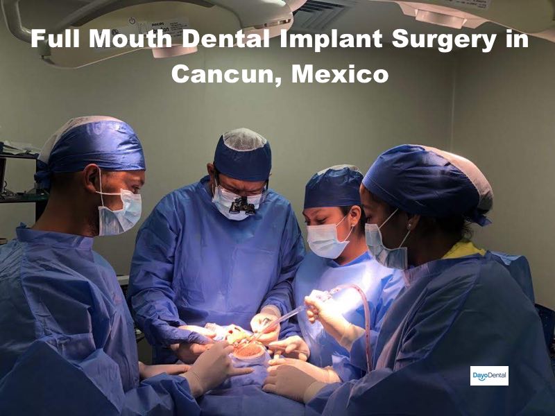 Full mouth restoration, reconstruction, rehabilityation in Cancun with dental implants