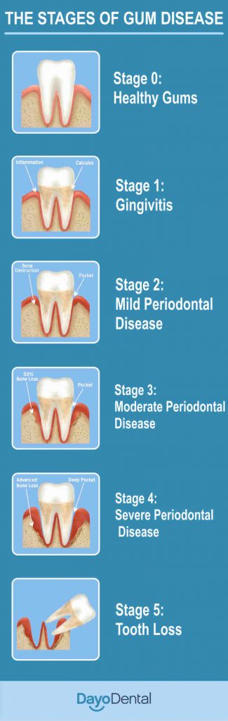 Stages Of Gum Disease New Dayo Dental