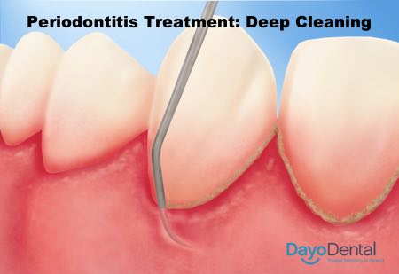 Periodontitis Treatment: Deep Cleaning