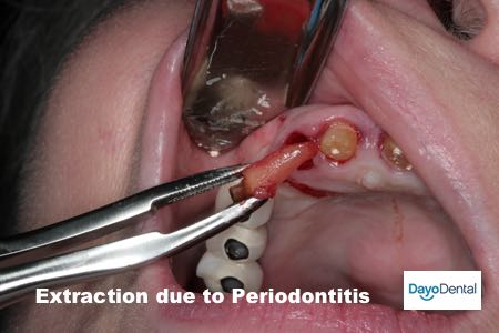 Extraction Periodontitis Full Mouth