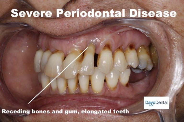 Your Ultimate Guide to Periodontal Disease  Periodontitis