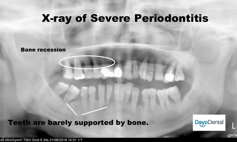 X-rays of Periodontitis, How do I know I have perio disease