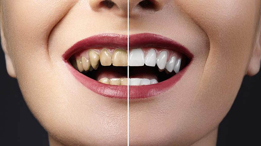 Close-up photo before and after whitening treatment or dental veneers procedure on teeth. Health Care collage of human mouth. Caries therapy