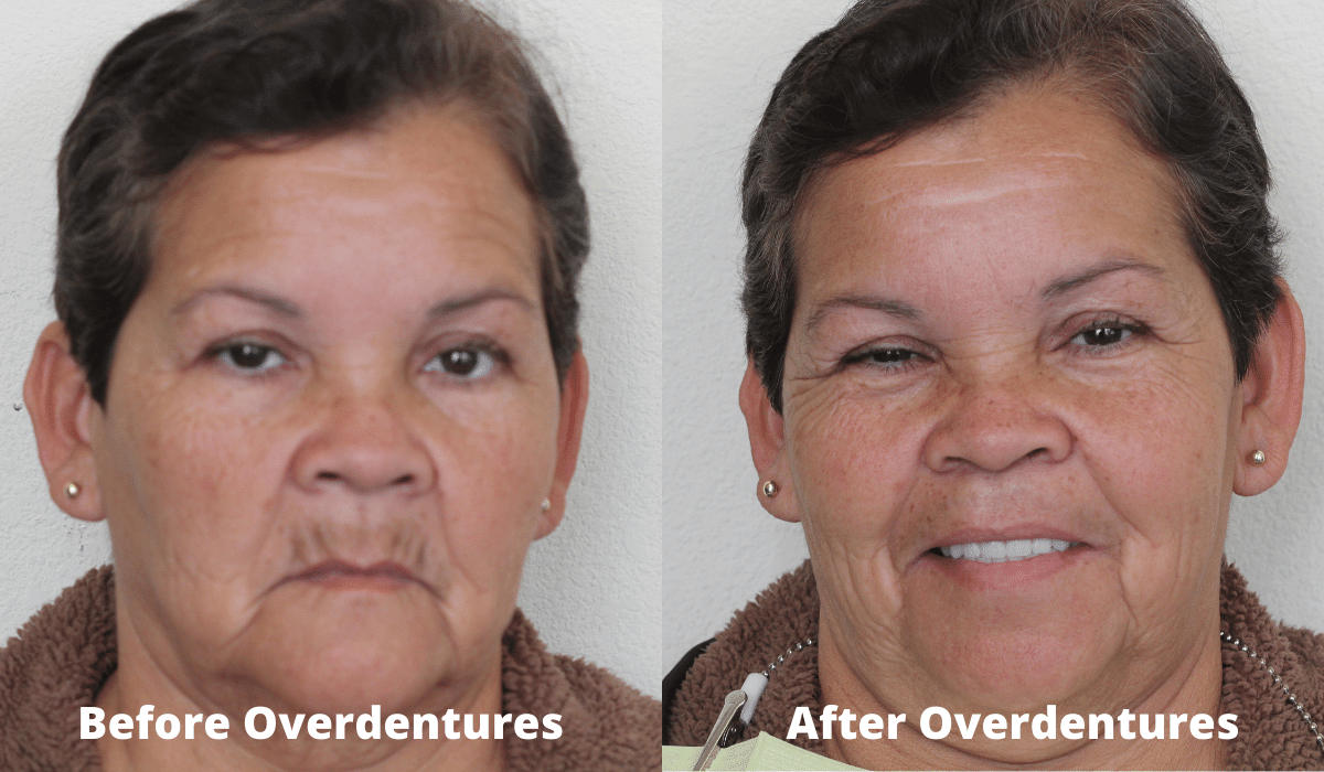 Before and After Overdentures in Los Algodones