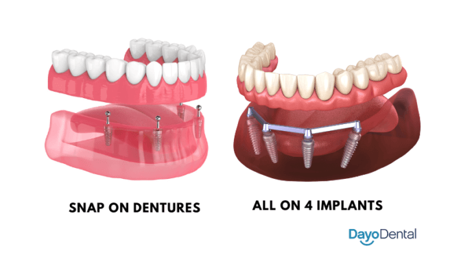 Snap-On Dentures vs. All-on-4 Dental Implants