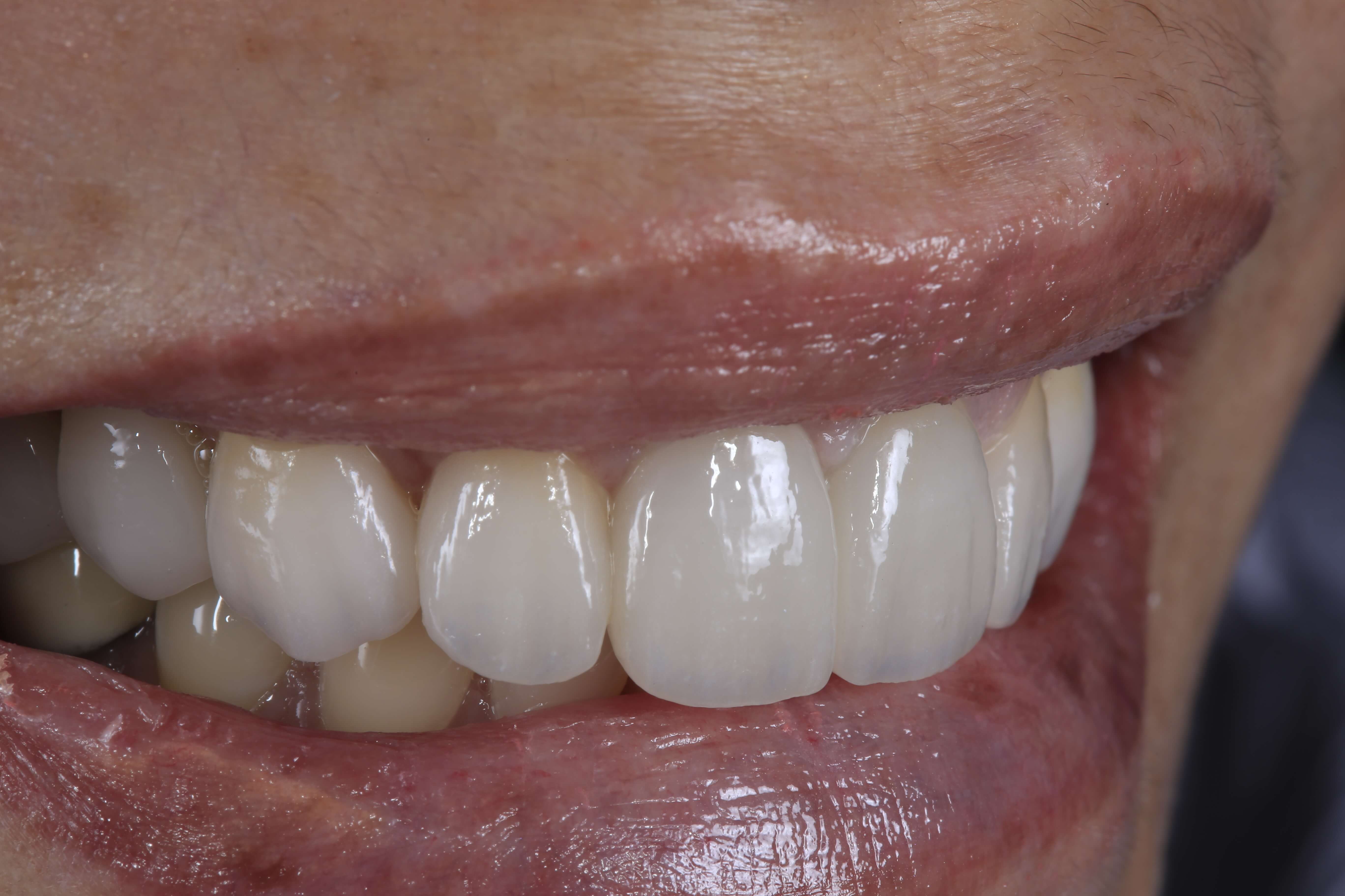 Two front teeth implants 