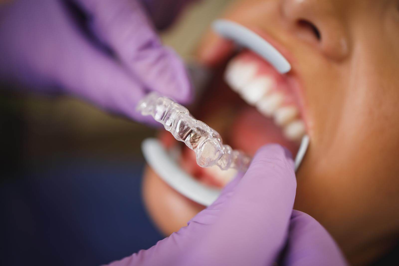 Invisalign for Correcting Overbite for Teenagers