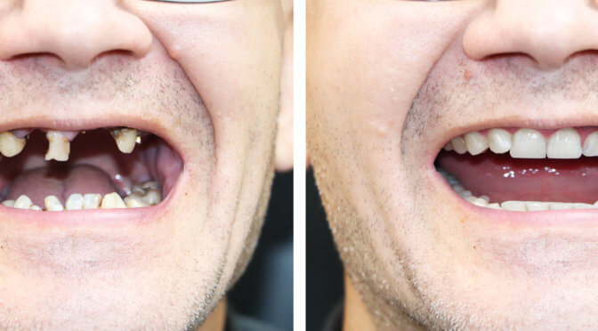 Before and After Dental Implants in Mexico