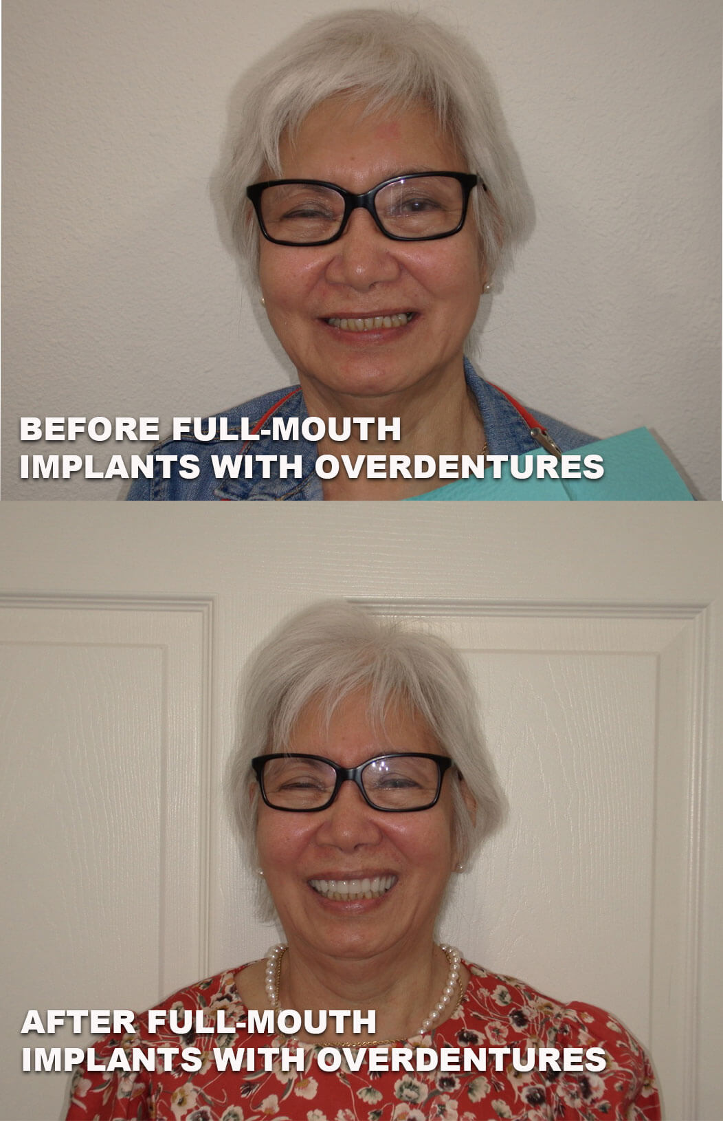 Before and after full mouth implants with overdentures