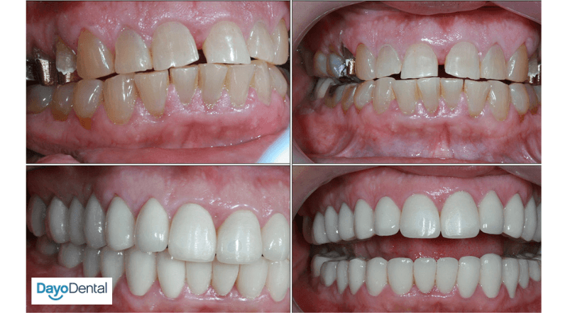 Full Mouth Reconstruction by a Top Dentist in Mexico